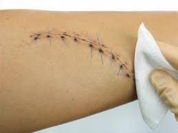 Comment enlever les points de suture ?